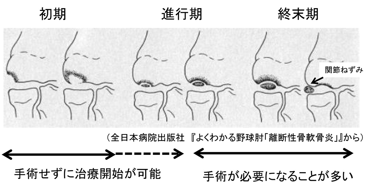 離断性骨軟骨炎（りだんせいこつなんこつえん）の進行過程